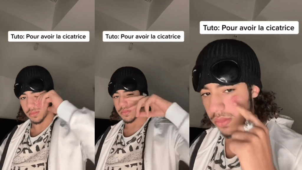 法国TikTok「伤痕挑战」（cicatrice challenge）参加者以特定手势揑出瘀痕。 网上图片