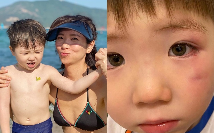 婉婉於IG分享了囝囝眼角現瘀青照。