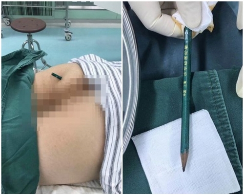 男生左侧屁股惨被一支铅笔深深刺入15厘米。网图