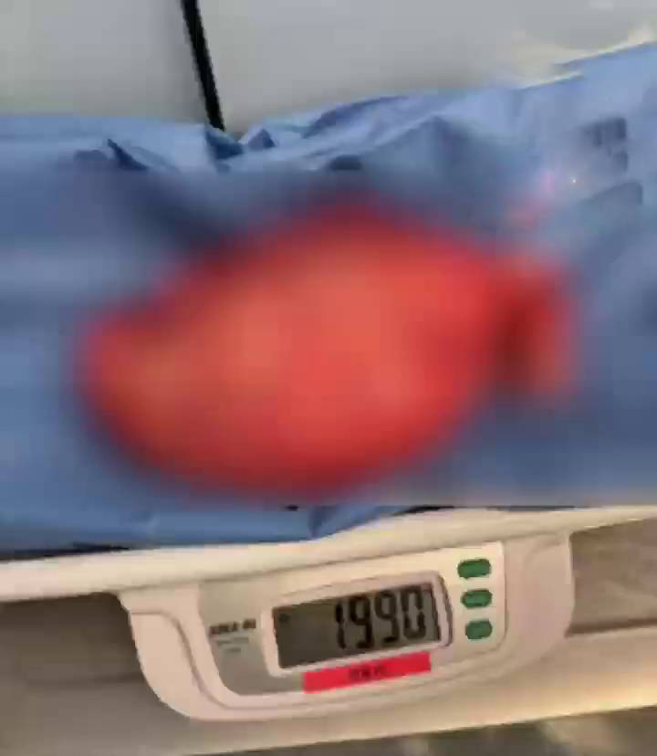 湖南16歲女孩肚大如懷胎八月,左腎查出2kg巨瘤,直徑長達27cm。 第一現場 湖南16歲女孩肚大如懷胎八月,左腎查出2kg巨瘤,直徑長達27cm。 第一現場
