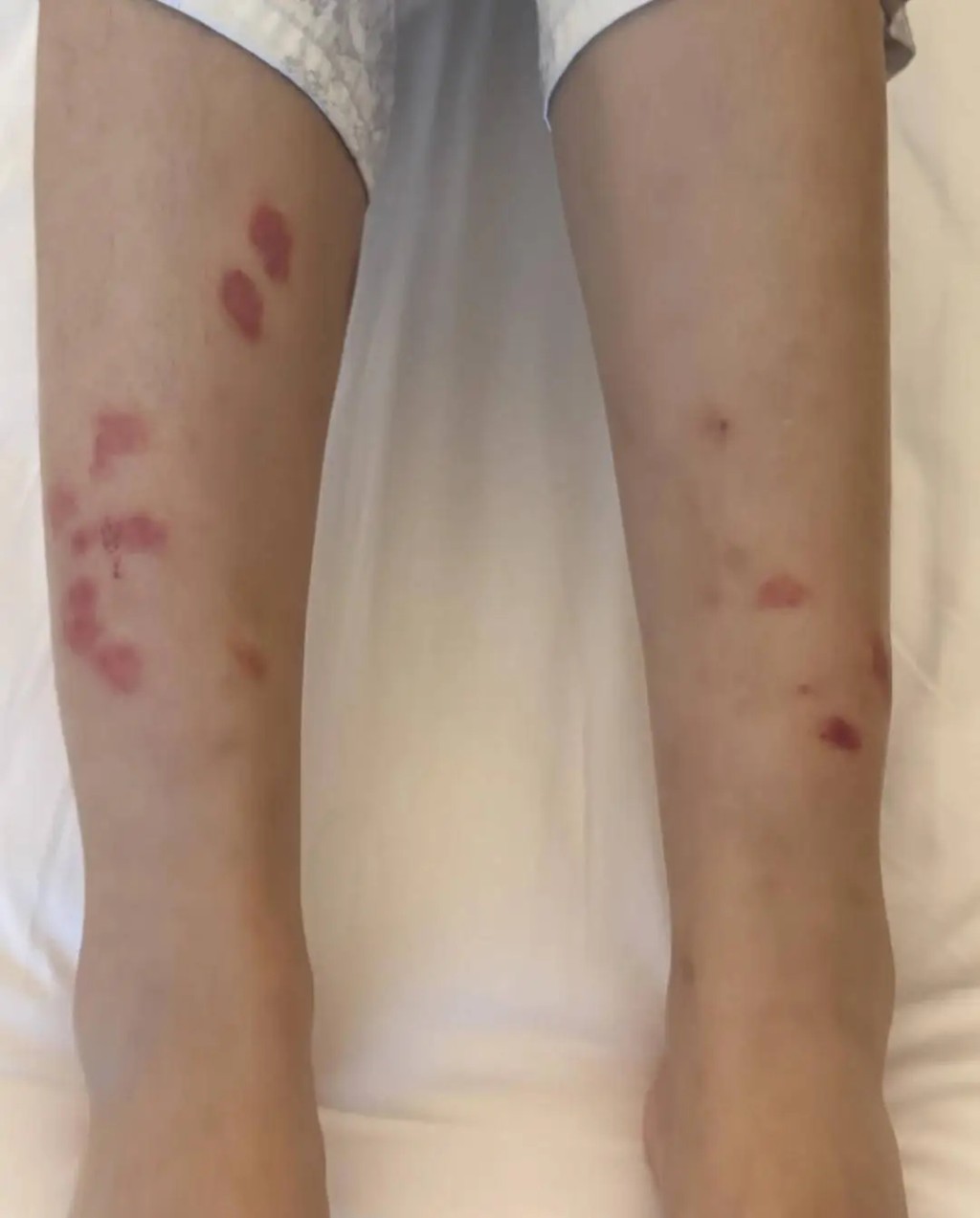 女事主雙腿慘遭咬出大片紅斑。 女事主雙腿慘遭咬出大片紅斑。