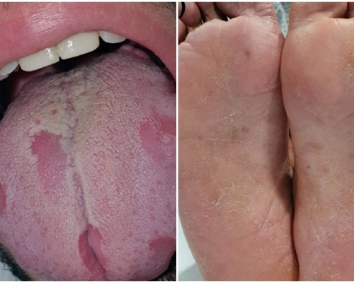 西班牙有研究團隊發現，確診者出現「新冠舌頭」病徵，手掌及腳掌均起紅點、出疹，甚至脫皮。網圖