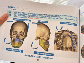 手术方案。