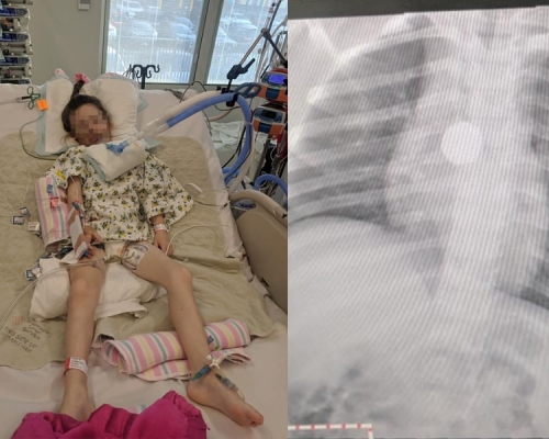 5歲女童暴瘦，多次就醫無果，拍X光片發現原來鈕扣電池惹禍。(網圖)