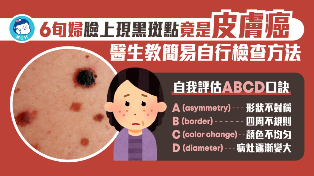 瞼上現奇怪黑斑點有機會是皮膚癌症狀,醫生教大家自行檢查的方法。