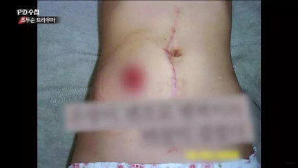 娜英當時大小腸流出體外,性器官及肛門喪失八成功能,須裝上人造肛門,終生使用尿袋。網圖
