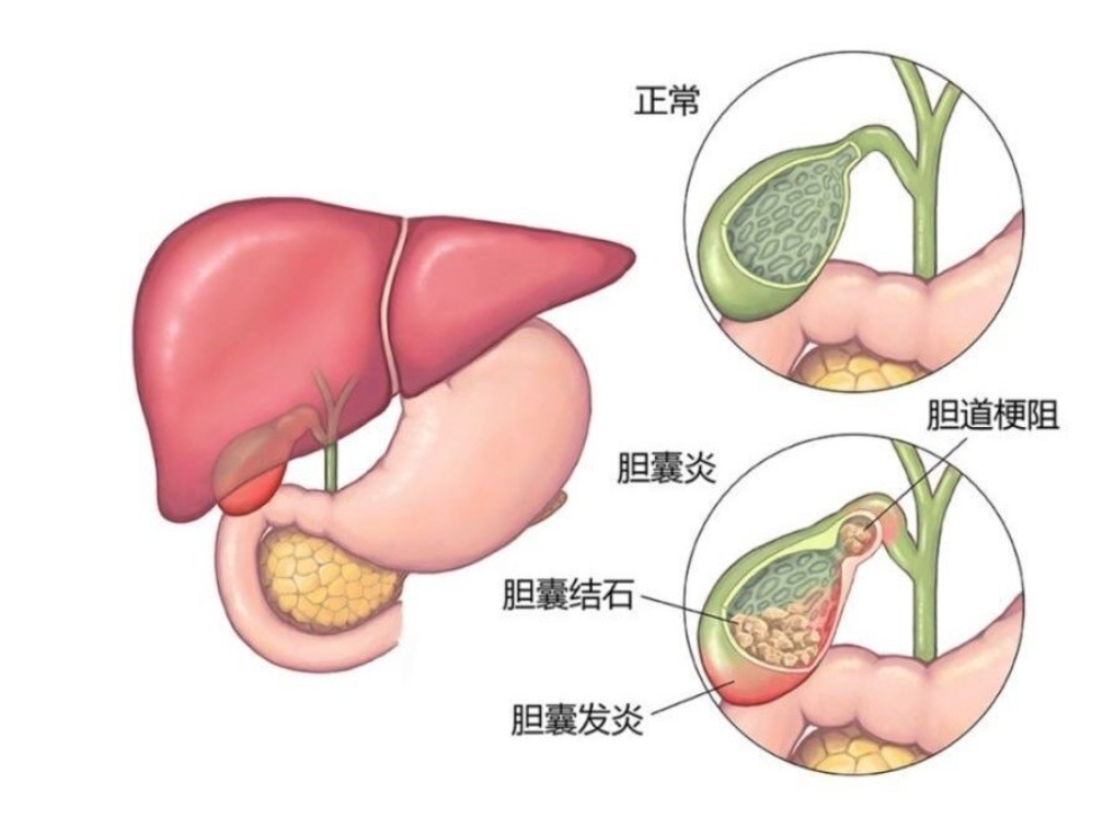 膽結石示意圖。 好大夫在線