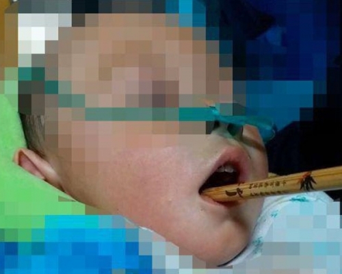 竹筷子插入男童的口腔，深入顱內。 網圖