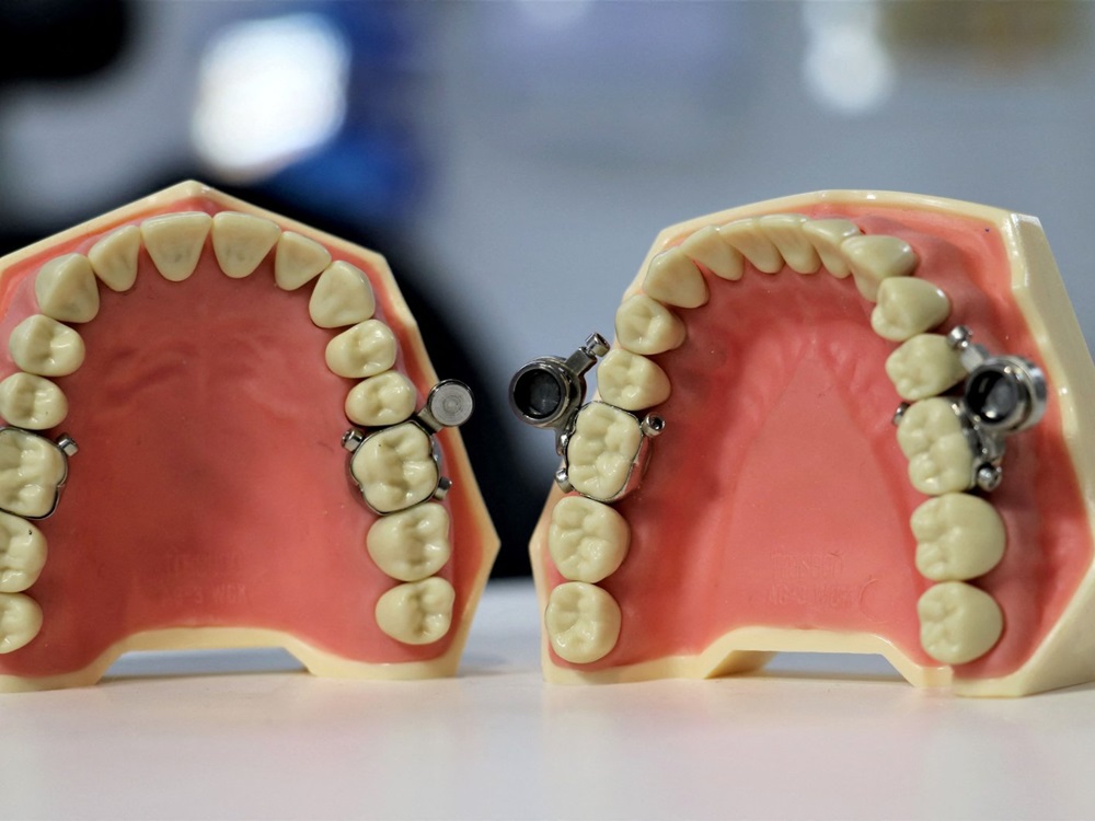 紐西蘭研究人員研發出1種新的減肥裝置，將磁鐵安裝在人的牙齒上，使人們不能容易張口。紐西蘭奧塔哥大學圖片