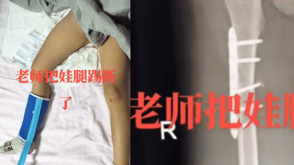 家長在網上公開孩子的傷勢。