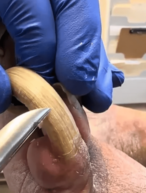 医生用钢剪为患者剪除灰甲。