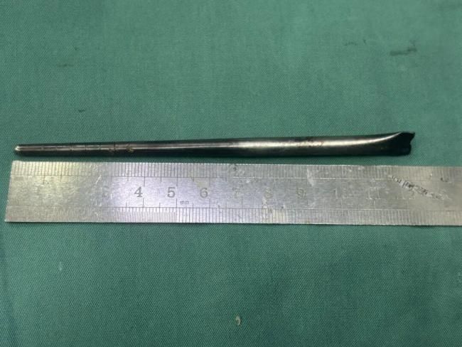 手術後取出的筷子。《瀟湘晨報》