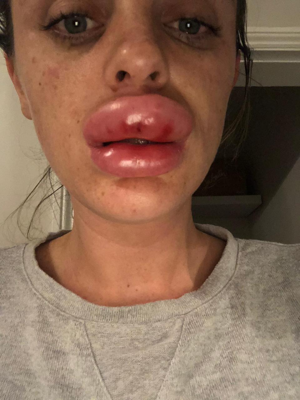 女子注射肉毒杆菌（Botox）及填充物后出现不适。网上图片