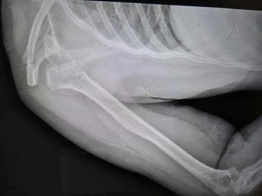 張大姐因不知患有癲癇症，睡夢中病發「震」斷自己手臂骨成七、八截。大河報