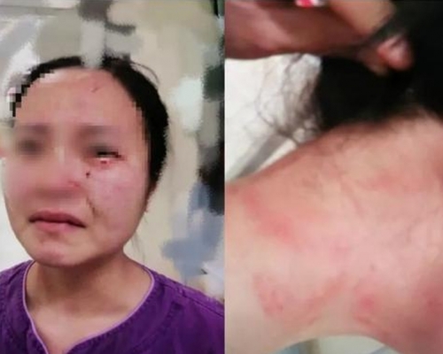 一名外籍新冠肺炎確診患者在廣州市第八人民醫院不配合治療、毆打並咬傷一名女護士。(網圖)