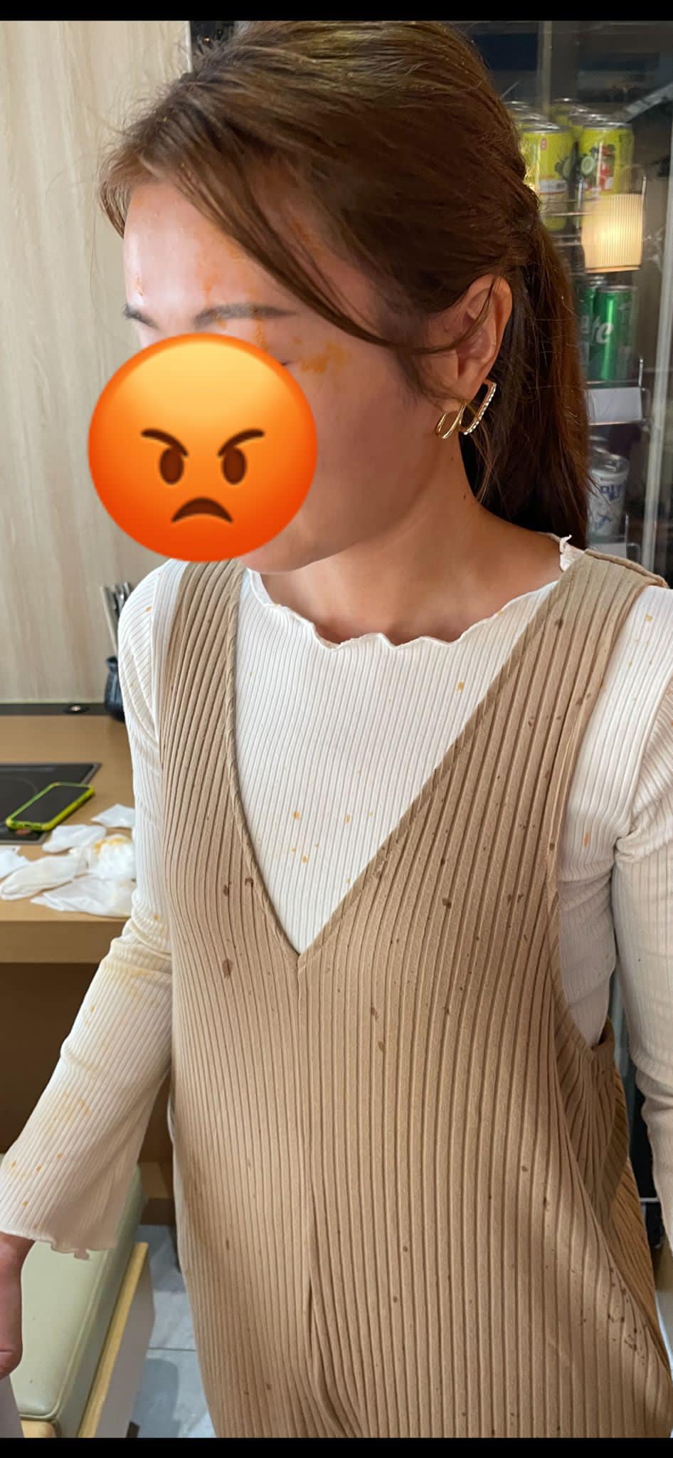 女事主的脸部被烫伤。网民Vicky Hung图片