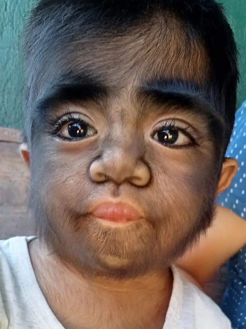 菲律賓一名2歲男童臉部及身上長滿毛髮，看起來就像「狼人」。FB@Ate mo JESS