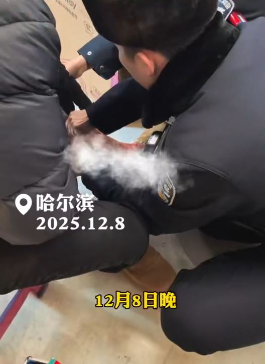 南方遊客未著打底褲，在哈爾濱-20℃氣溫下，凍爆靜脈曲張的血管。平安哈爾濱