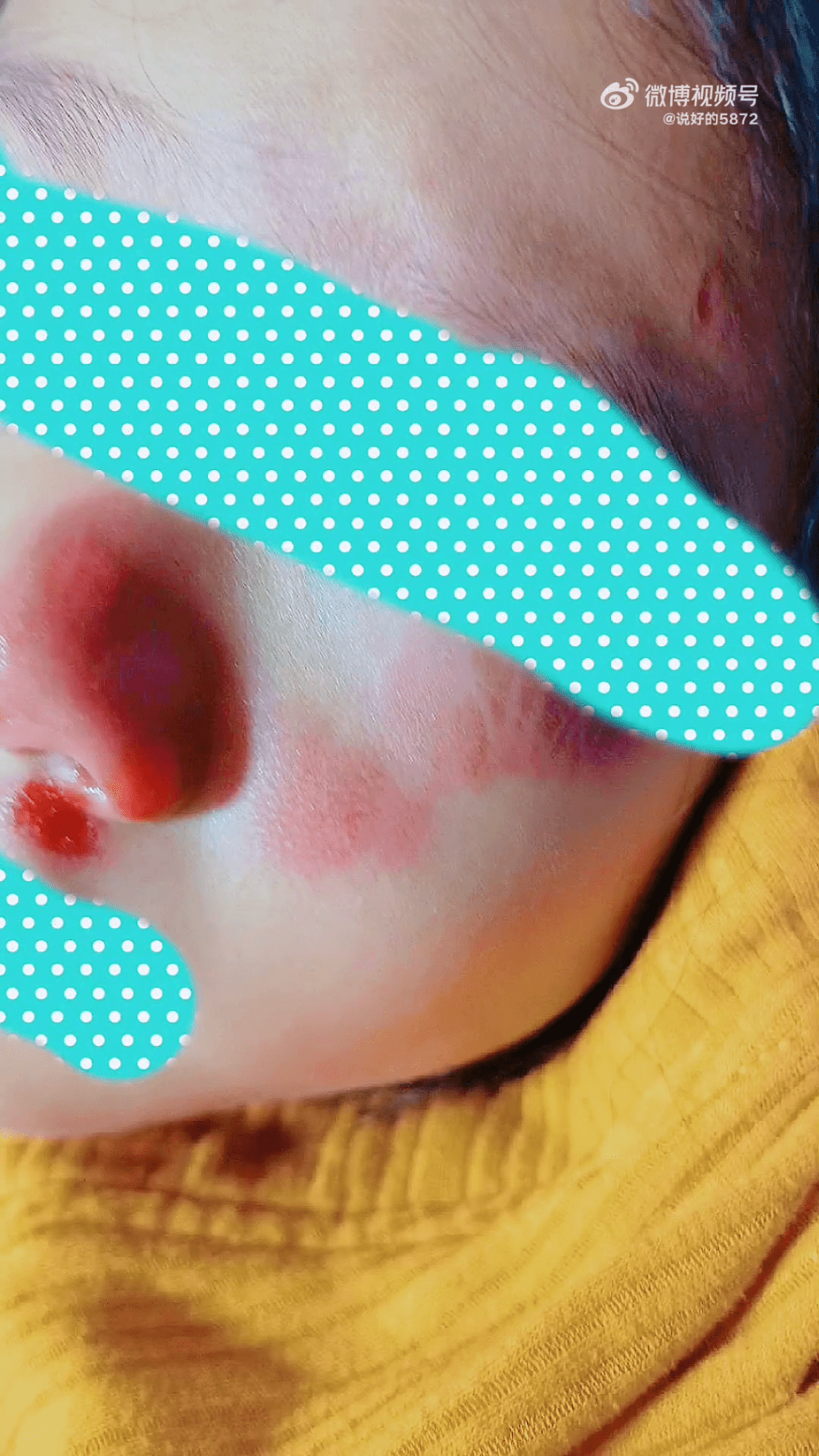 女童鼻子、額頭、左腮等面部多處受傷。網圖