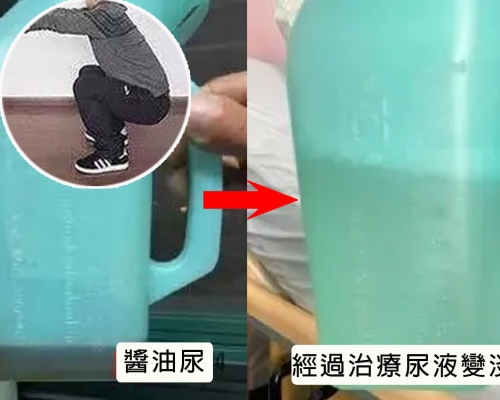 經過治療尿液變淡。