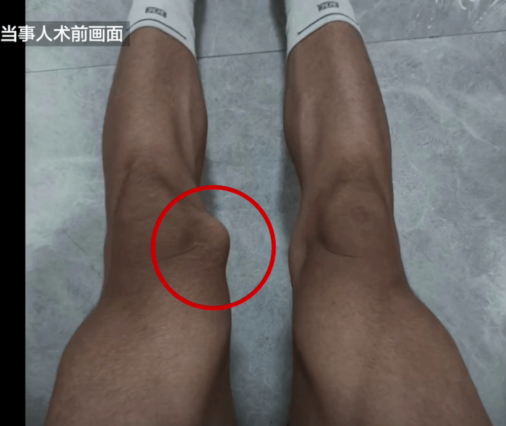 當事人手術前腳部的照片，左腳明顯骨頭凸出。