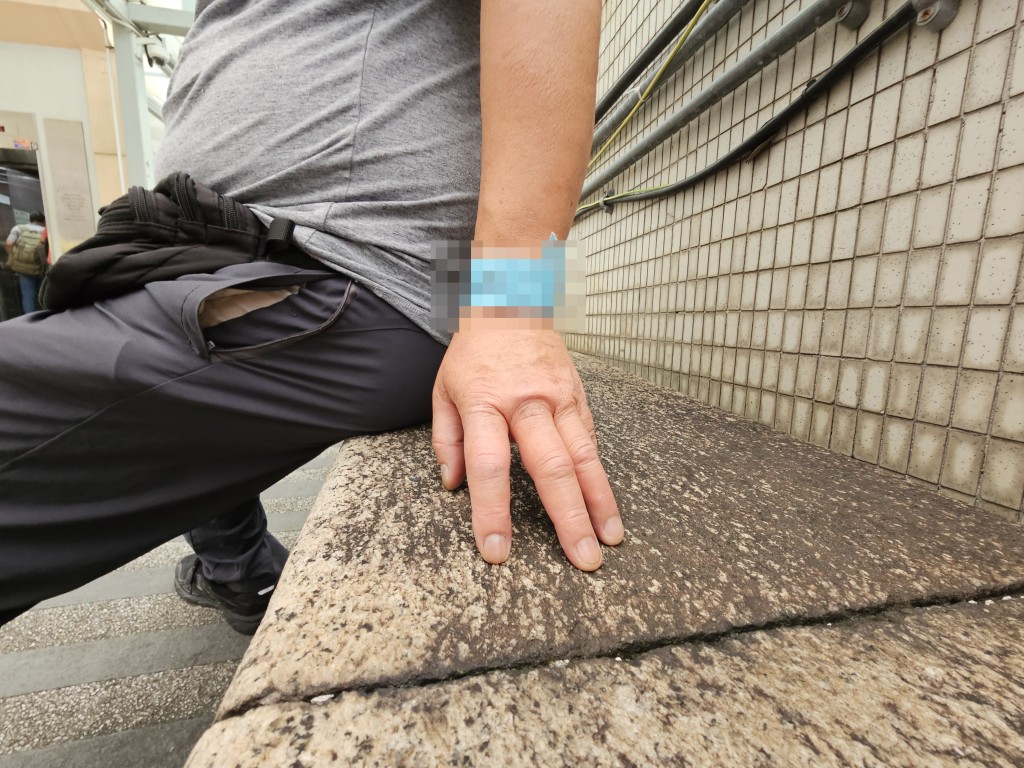 一名男工人的雙手被螫傷至腫起。 一名男工人的雙手被螫傷至腫起。