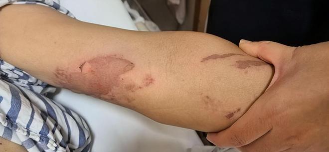 浙江女用乾冰助六旬父退燒,反致其一身水泡紅腫。澎湃新聞 浙江女用乾冰助六旬父退燒,反致其一身水泡紅腫。澎湃新聞