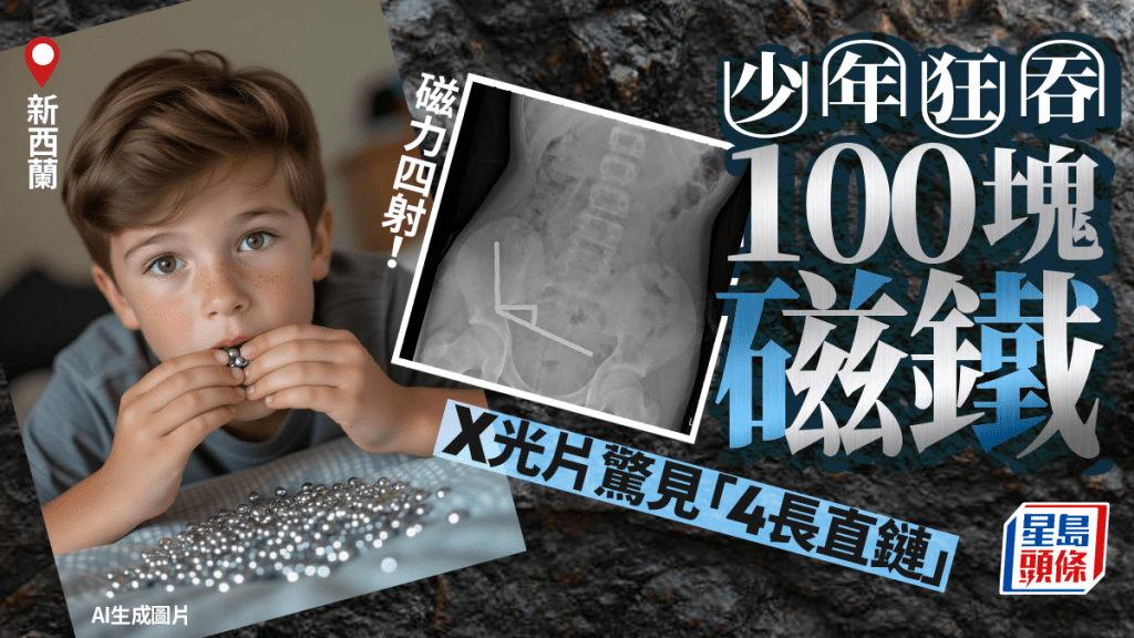 新西蘭少年吞食100塊磁鐵 組織壞死要切除部分腸道