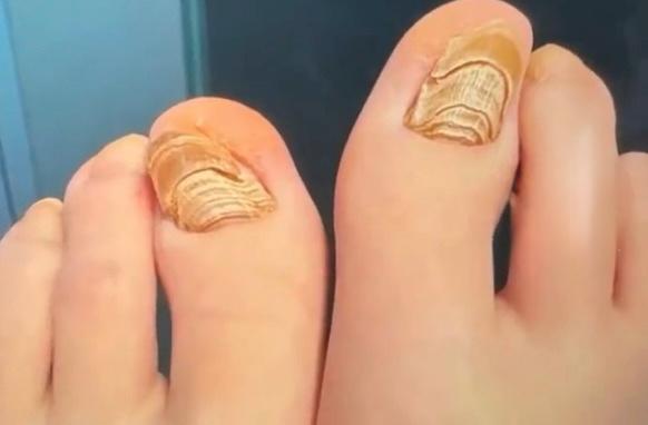 穿襪睡覺睡出「千層甲」。三農頻道