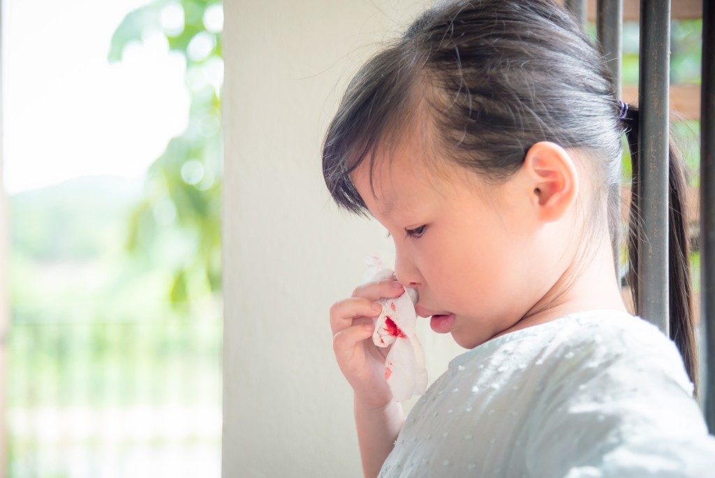 流鼻血是否一定是「熱氣」？（圖片來源：Shutterstock）