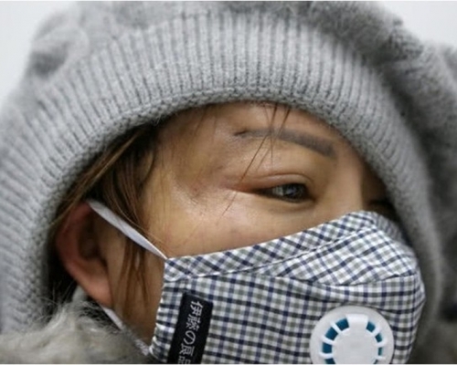 女子透過手術將已病變組織及注射物取出,惟太陽穴處出現凹陷。(網圖)