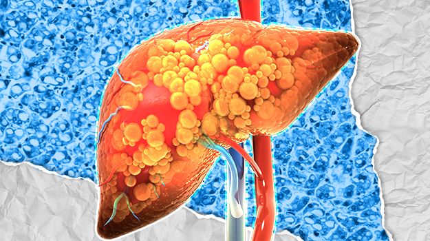 肝臟脂肪堆積引起非酒精性脂肪性肝炎。網上圖片