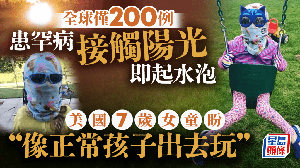 全球僅200例 美女童患「吸血鬼病」 皮膚一接觸陽光即起泡灼痛