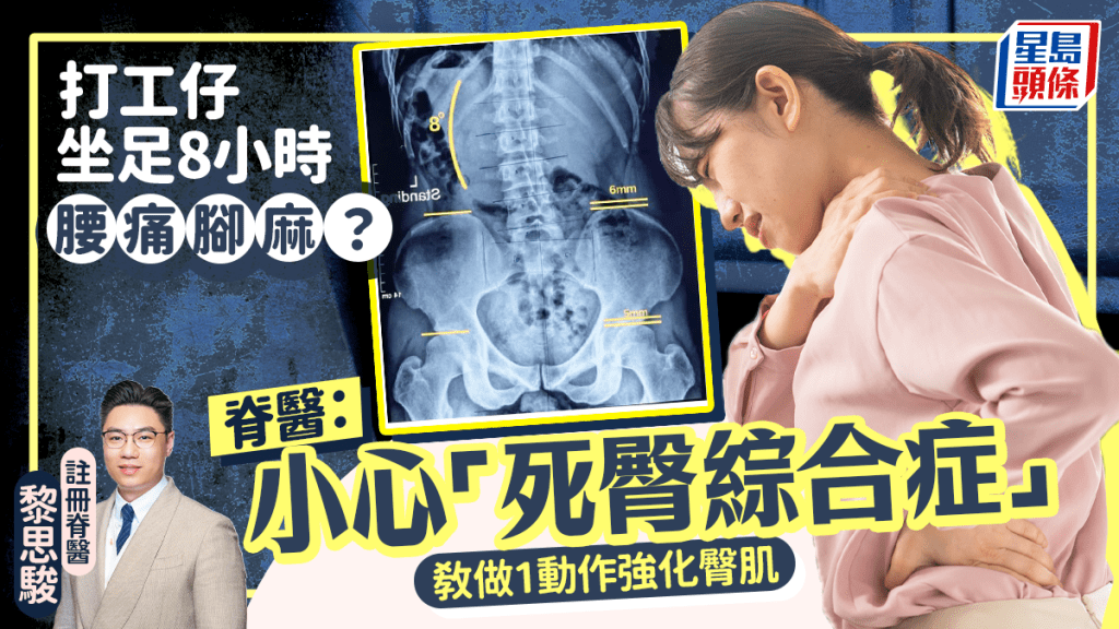 打工仔一日坐足8小時腰痛腳麻？脊醫：小心「死臀綜合症」 教做1動作強化臀肌
