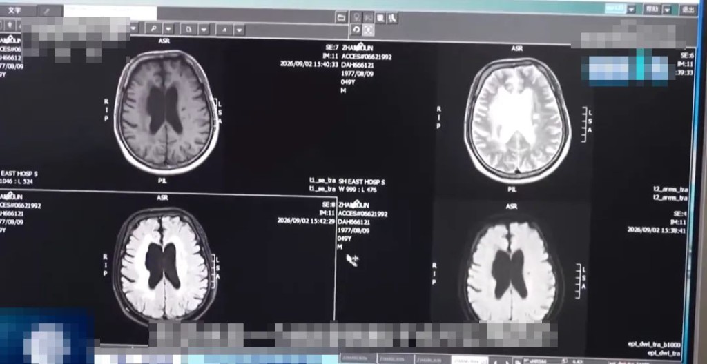 張先生大腦出現嚴重萎縮。央視截圖 張先生大腦出現嚴重萎縮。央視截圖