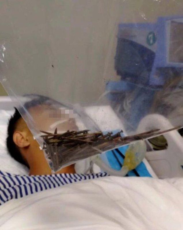 男子經過4小時手術後甦醒。網圖