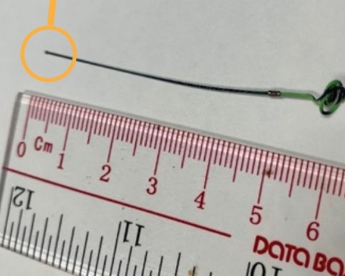 約6厘米的取石器碎片留在病人體內。《風險通報》季刊圖片