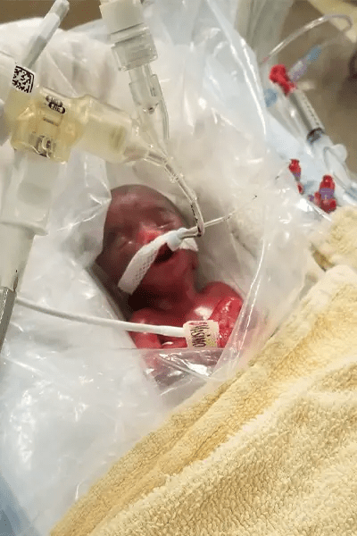 龍鳳胎的女嬰阿迪亞，出生時的體重只有330克。健力士官網