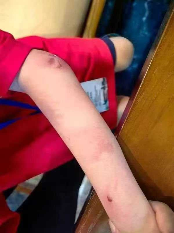 朱宏鑫曾多次被發現滿身傷痕。微博 朱宏鑫曾多次被發現滿身傷痕。微博