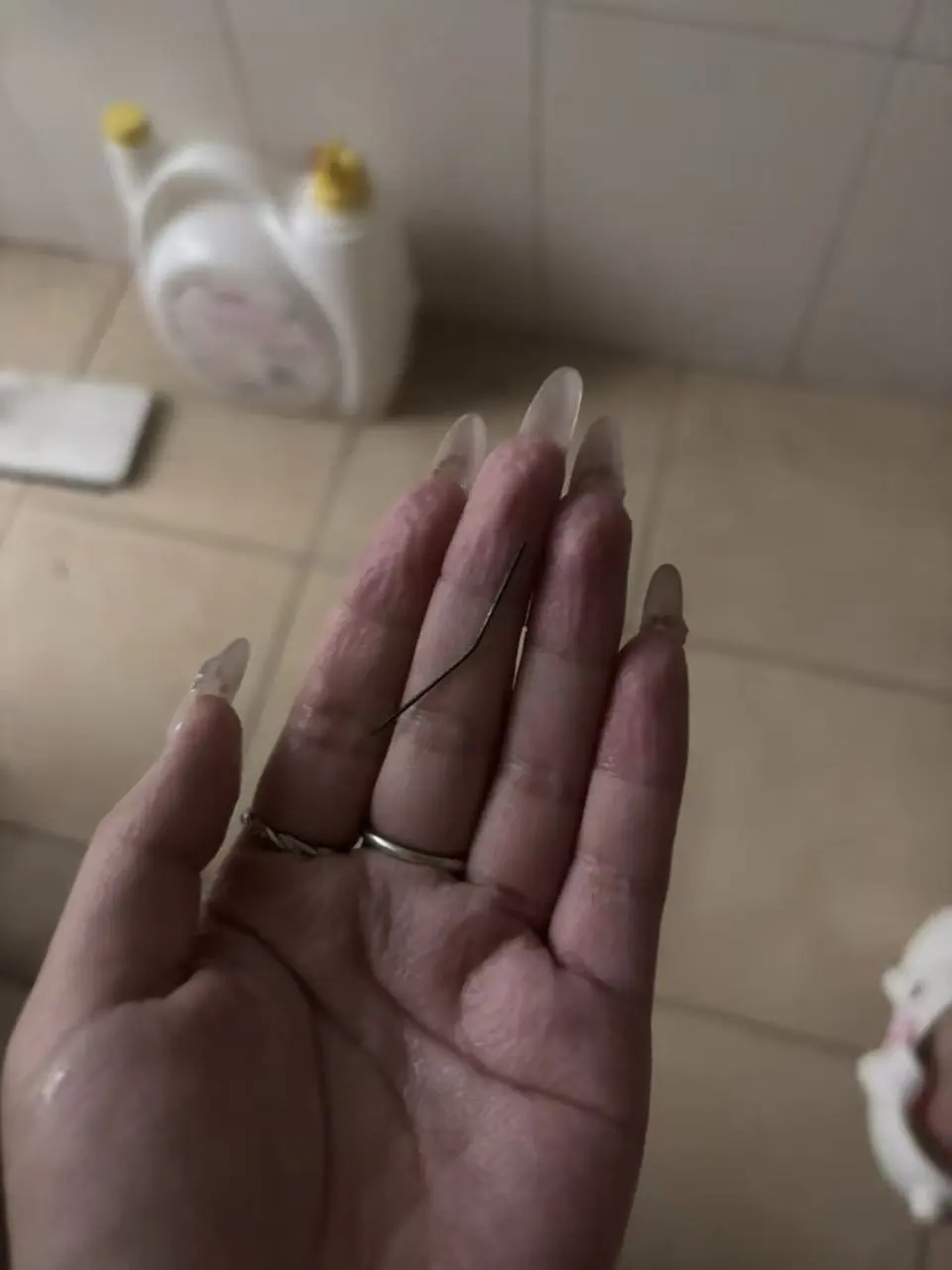 浙女左臀劇痛1個月,自拔4cm生鏽發黑針頭。 浙女左臀劇痛1個月,自拔4cm生鏽發黑針頭。