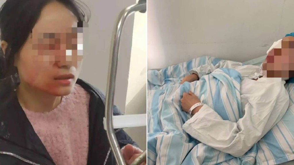 女教師因勸架被女小學生用鉗仔插傷右眼。南方都市報
