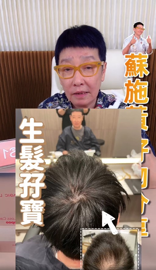 蘇施黃展示化療後遺症,頭頂脫髮。 蘇施黃展示化療後遺症,頭頂脫髮。