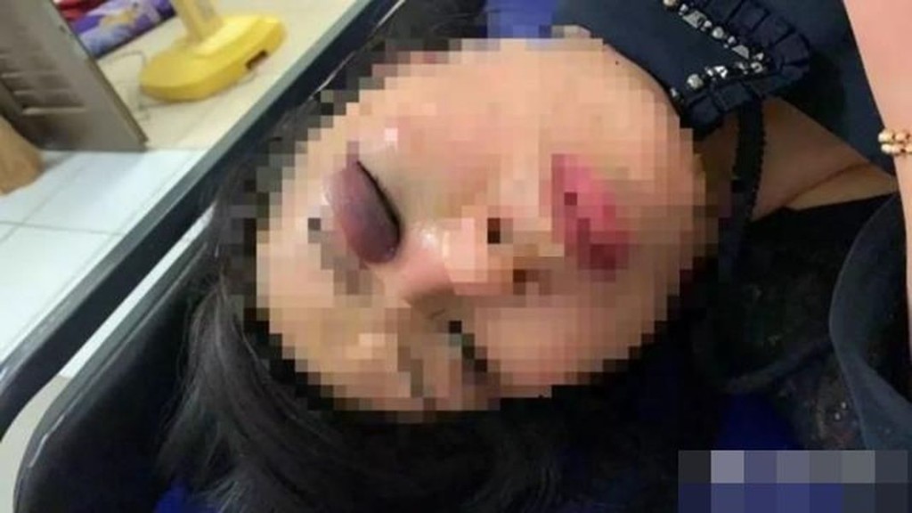兩夫婦遭打至傷痕纍纍。網圖