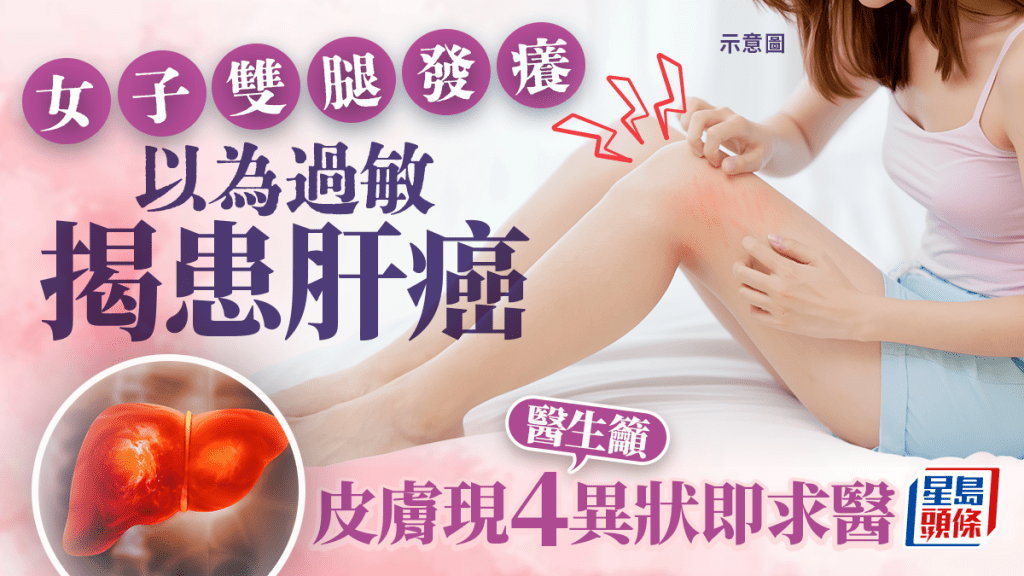 女子雙腿發癢以為皮膚過敏 求醫揭患肝癌 醫生籲皮膚現4異狀要留神