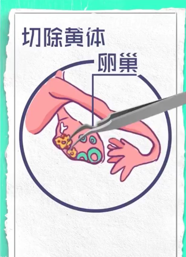 26的婷婷與男友床上「激戰」後黃體破裂險死。第一現場