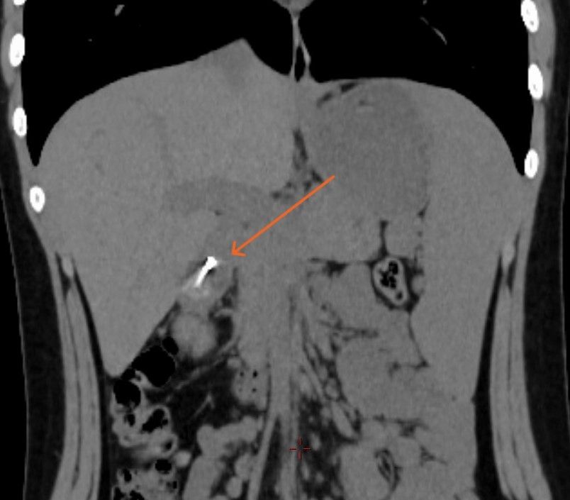 男孩誤吞圓規針，要由醫護團體透過手術取出。《現代快報》