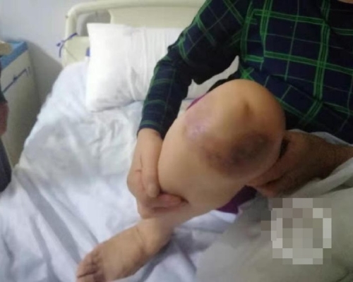 已達115人感染上膿腫分枝桿菌。網圖