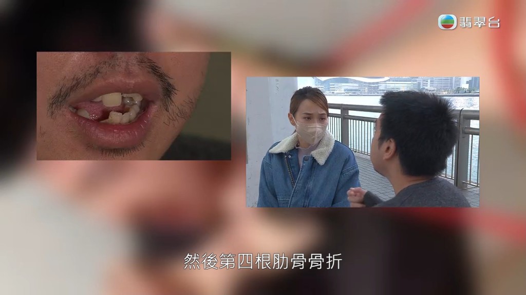 陳先生被打崩牙，又被打斷肋骨，最後昏迷3日，在加護病房留醫近一個月。