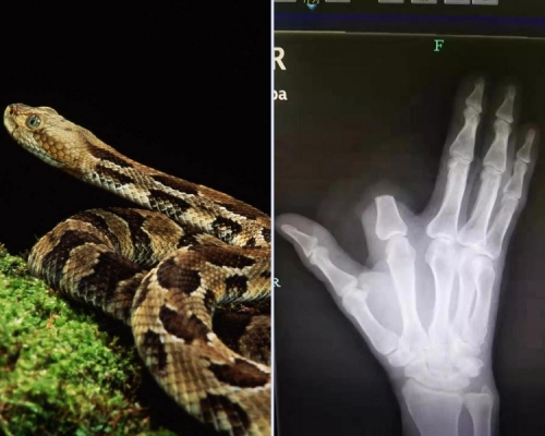 張先生被五步蛇咬中後，立即砍了食指。醫生慨嘆︰「其實完全沒必要。」 （網圖）