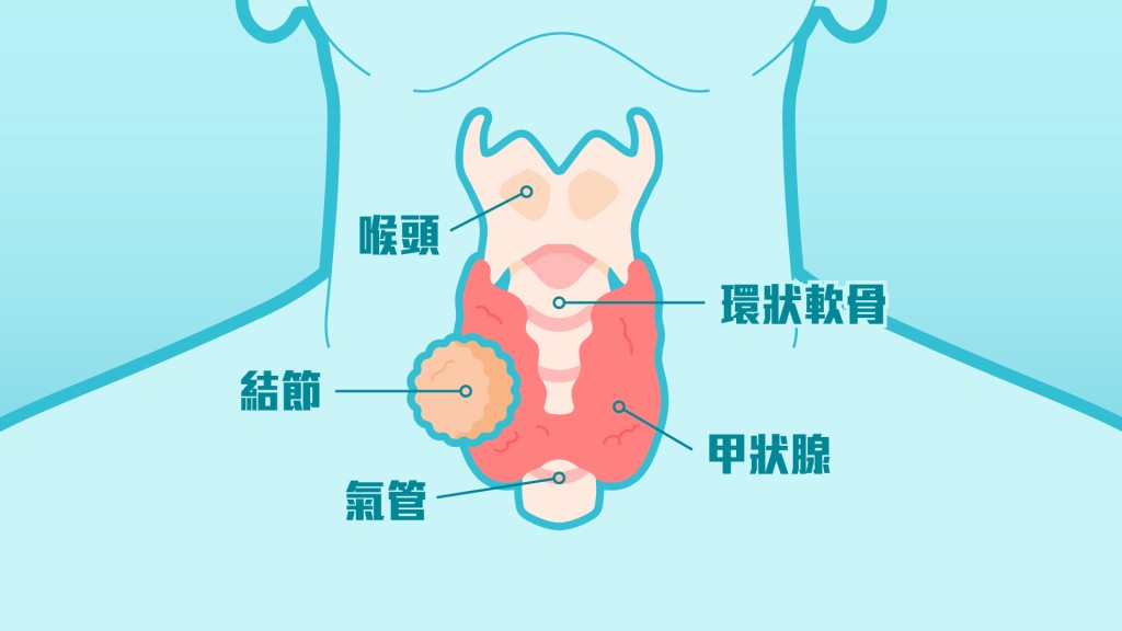 甲狀腺 甲狀腺